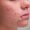 Acne Scars