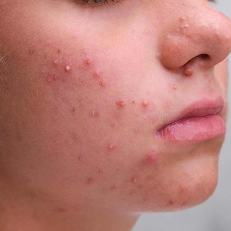 Acne Scars