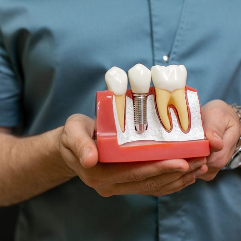 Dental-Implants