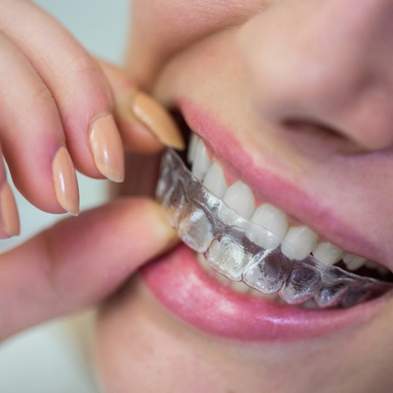 Orthodontic Treatment